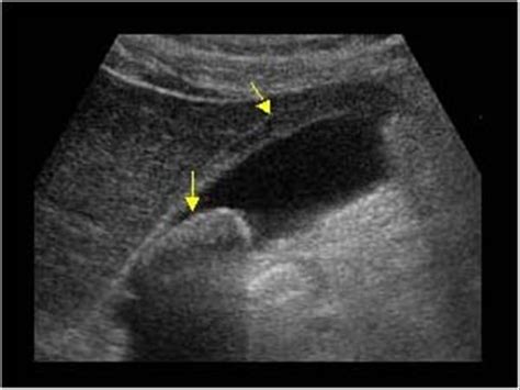 Chronic Cholecystitis Definition, Causes, Symptoms, Treatment | eHealthStar