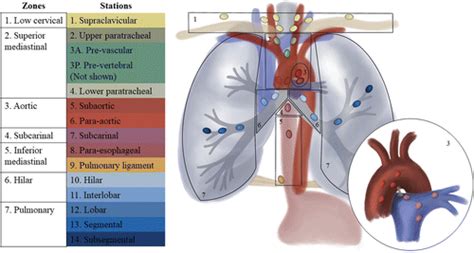 Mediastinal Lymphadenopathy in the National Lung Screening Trial (NLST) Is Associated with ...