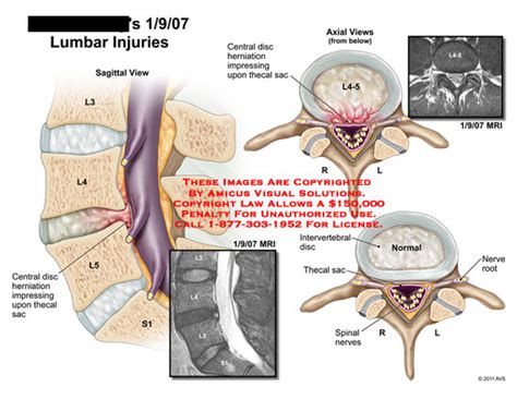 Thecal Sac Mri | www.pixshark.com - Images Galleries With A Bite!