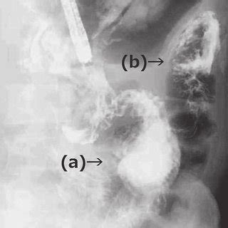 The upper gastrointestinal series demonstrated the fistula from the... | Download Scientific Diagram