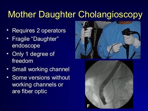 Cholangioscopy for sri