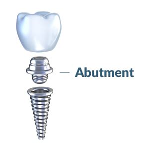 Elk Grove Custom Dental Implant Abutment | Sacramento