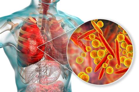 Walking Pneumonia: What Is Walking Pneumonia?