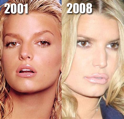 Jessica Simpson Plastic Surgery Before and After Lips and Collage Injection | Plastic Surgery