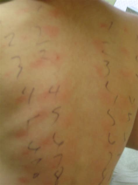 SYMPTOMS OF MOLD ALLERGY : SYMPTOMS OF - BLADDER INFECTION SYMPTOMS WOMEN