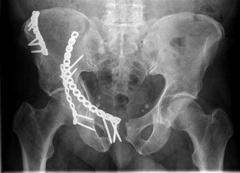 Where Does Pelvic And Acetabular Fracture Treatment Fit Into The Newly ...