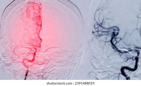 Cerebral Angiogram Medical Imaging Procedure Used Stock Photo 2391488019 | Shutterstock