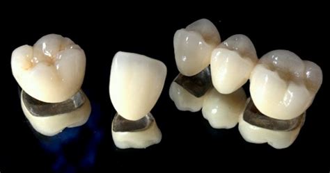 Porcelain-Fused-To-Metal (PFM) Crown And Bridge ~ Dr. Bharat Katarmal Dental & Implant Clinic