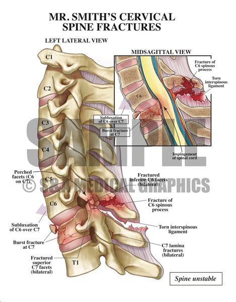 Cervical Spine Injury - S&A Medical Graphics