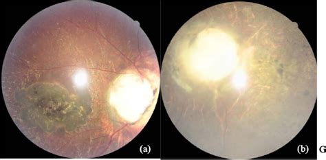 (a) Morning Glory Syndrome with small vessels and deep macular... | Download Scientific Diagram