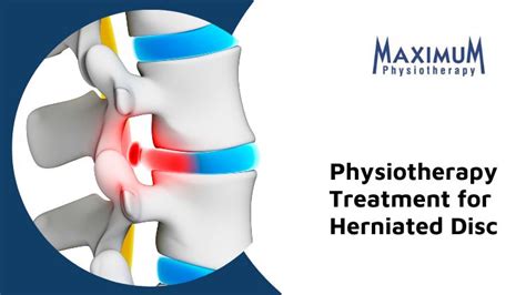 What To Expect With Physiotherapy If You Experience A Herniated Disc ...