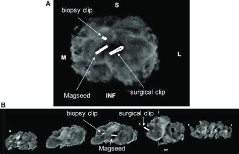 Segmental mastectomy specimen radiographs. A, Whole specimen radiograph... | Download Scientific ...