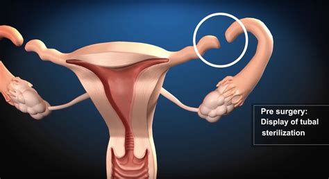 Tubal Ligation Reversal | Tubal reversal, Tubal ligation, Tubal ligation reversal