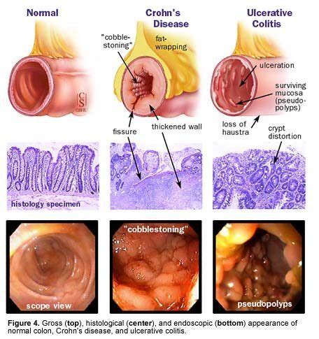 What Causes Ulcerative Coalitis | Naperville Inst. | Dr. Hagmeyer