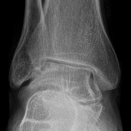 Subchondral fracture | Radiology Reference Article | Radiopaedia.org