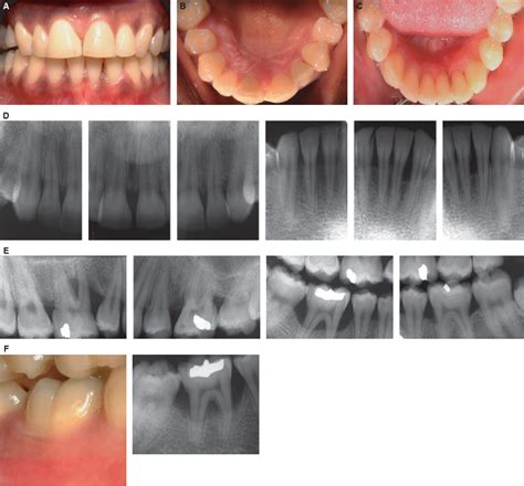 Figure 7 from Comparison of the clinical features of chronic and aggressive periodontitis ...