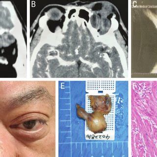 Clinical symptoms and signs of orbital neurilemmoma | Download ...