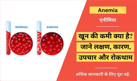 एनीमिया - Anemia in Hindi, Types, Cause, Treatment, Prevention