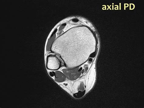 The Radiology Assistant : Ankle - MRI examination