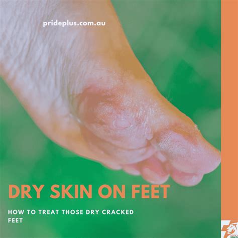 Dry Skin On Feet | And 3 Tips To Fix