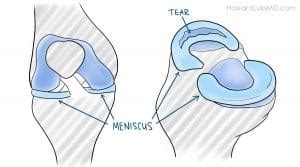 Posterior Horn Medial Meniscus Tears - Howard J. Luks, MD | Aranjuez