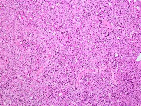 Pathology Outlines - Parathyroid adenoma