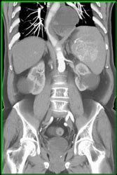 Islet Cell Tumor- See Next Case - Musculoskeletal Case Studies - CTisus ...