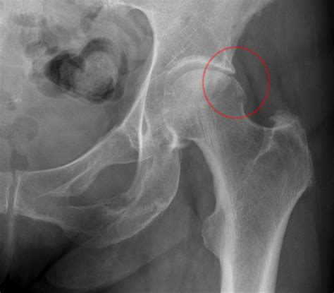 Things You Should Know About Hip Pain due to Hip Impingement and Your X-ray Findings ...