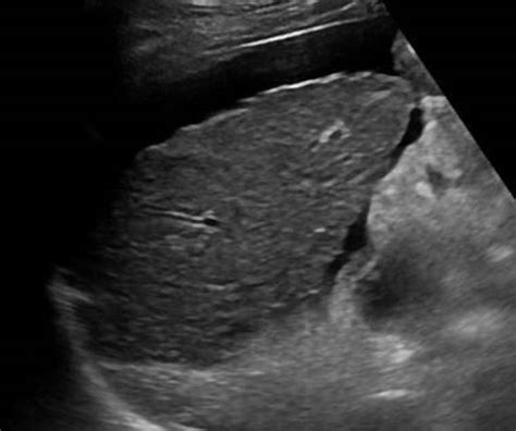 Abdominal Distension | Case Studies | POCUS.org