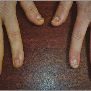 Diffuse onychoptosis involving all fingernails | Download Scientific Diagram