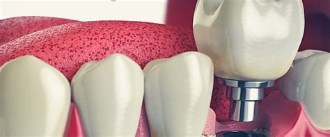 What To Expect During A Tooth Extraction Procedure With An Austin ...