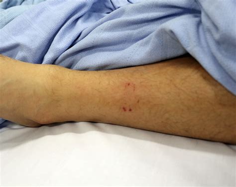 Moranbah man survives deadly snake bite - Mackay Hospital and Health Services