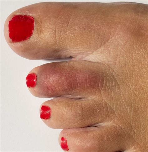 Broken toe: Symptoms, pictures, and treatment