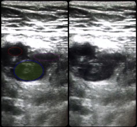 Deep Venous Thrombosis, Ultrasound, Annotated. JETem 2017 - JETem