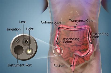 Pin on Los Angeles Colonoscopy