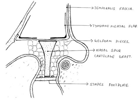 Showing long columella ossiculoplasty (myringoplatinopexy) with... | Download Scientific Diagram