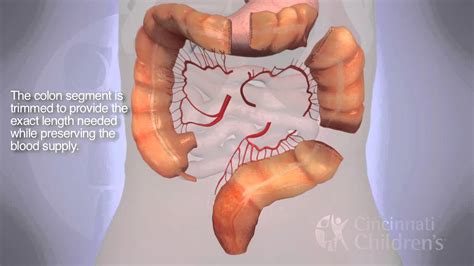 Colonics Procedure