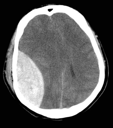 Neuroradiology for students (curriculum) | Radiology Reference Article | Radiopaedia.org