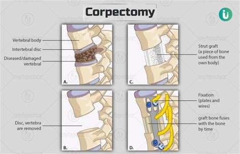 Corpectomy: Procedure, Purpose, Results, Cost, Price