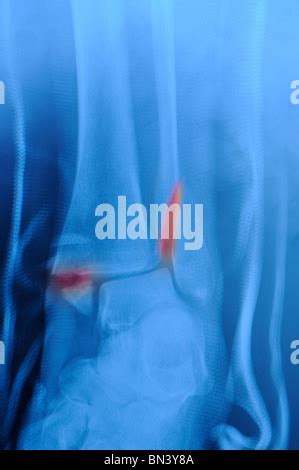 bimalleolar ankle fracture in a fiberglass splint Stock Photo - Alamy