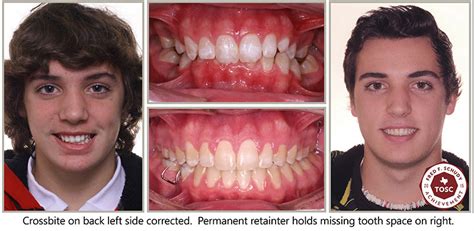 Before and After - Scott Orthodontics | Webster TX