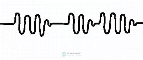 Biot's Breathing Pattern: An Overview (2024)