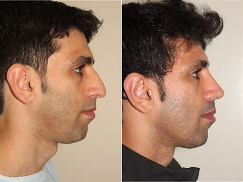 Popular Facial Cosmetic Procedures For Men - Dr. Denton