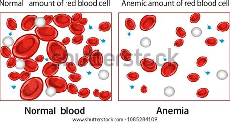 Vector Illustration Anemia Diagram Stock Vector (Royalty Free ...