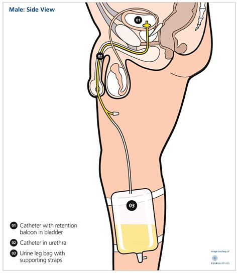 You and your catheter — Urology Associates