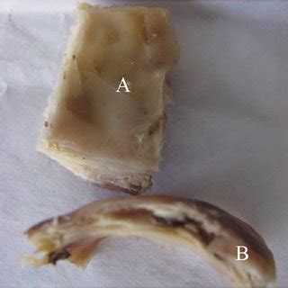 Histological examination of the removed wall of porcelain gallbladder.... | Download Scientific ...