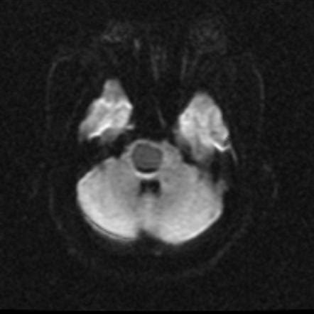 Neuroglial cyst - brainstem | Image | Radiopaedia.org