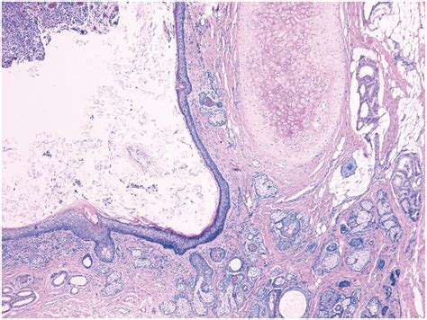 Branchial Cleft Cyst Histology