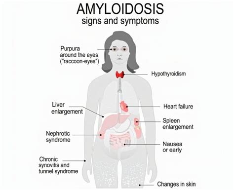 Multiple Myeloma; 14 Multiple Myeloma Symptoms & Multiple Myeloma Treatment - Page 13 of 16 ...