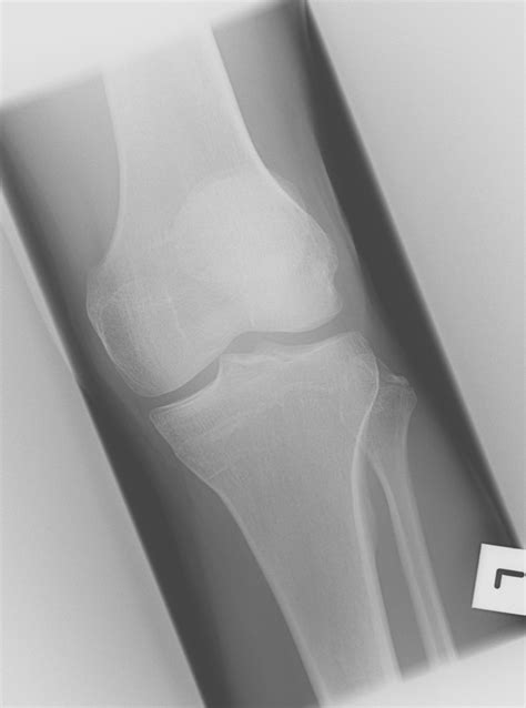 Fibular Avulsion Fracture